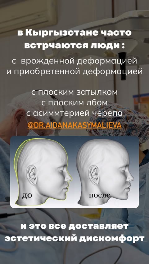 Краниопластика