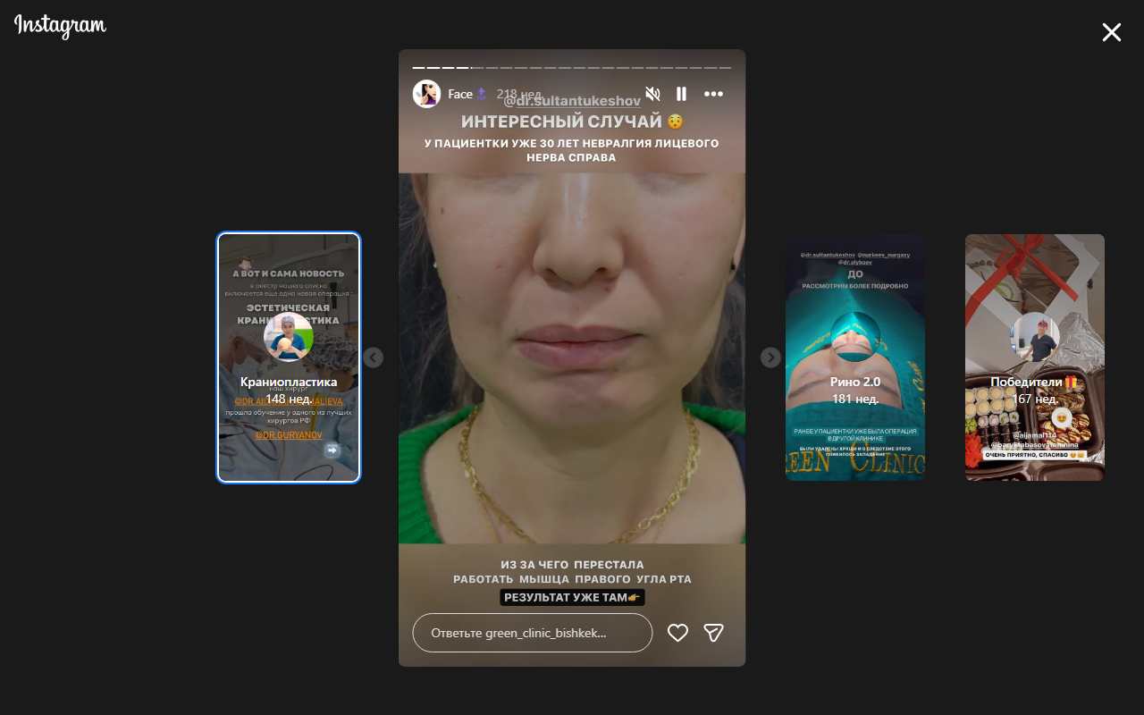 Блефаропластика — до