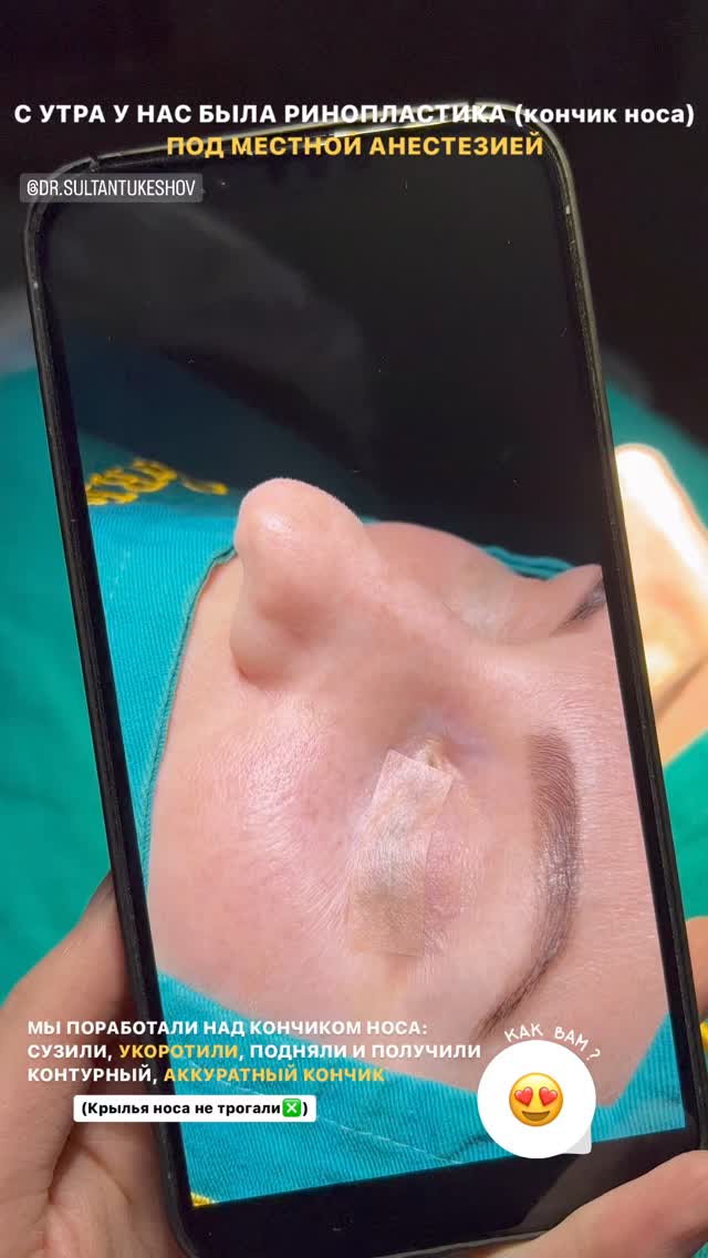 Ринопластика