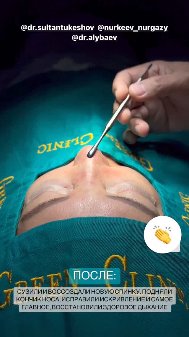 Ринопластика до и после
