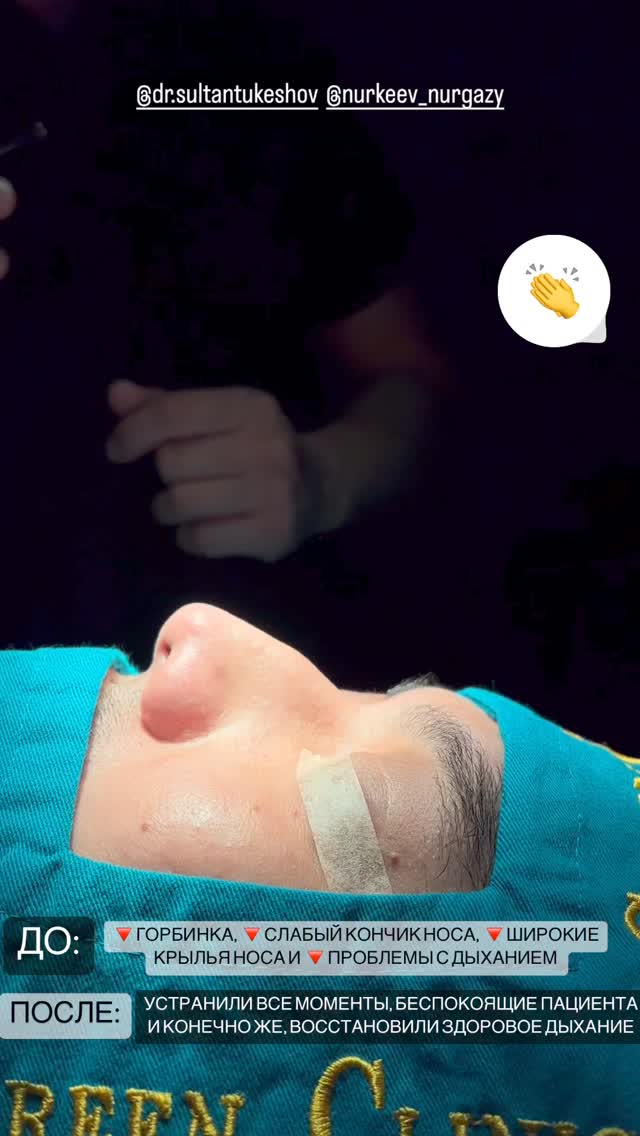 Ринопластика