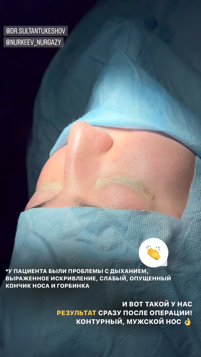 Ринопластика 2.0