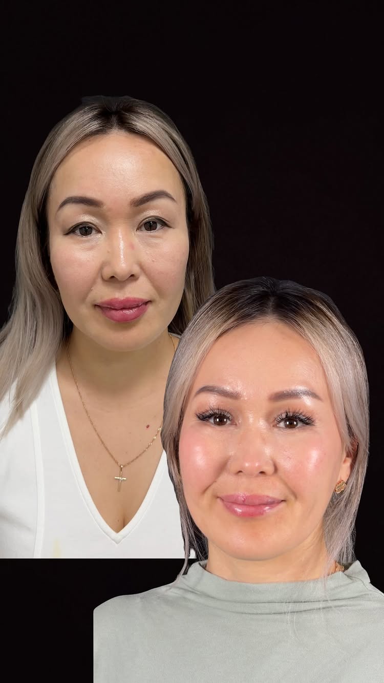 Блефаропластика круговая