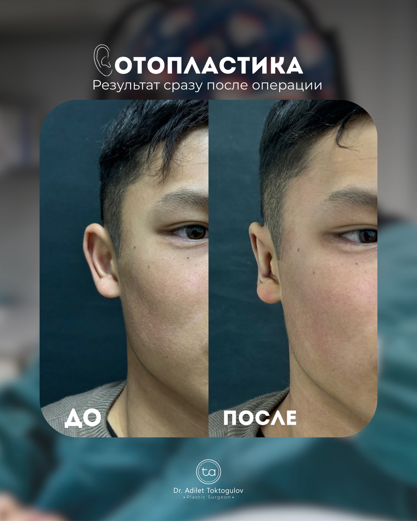 Отопластика