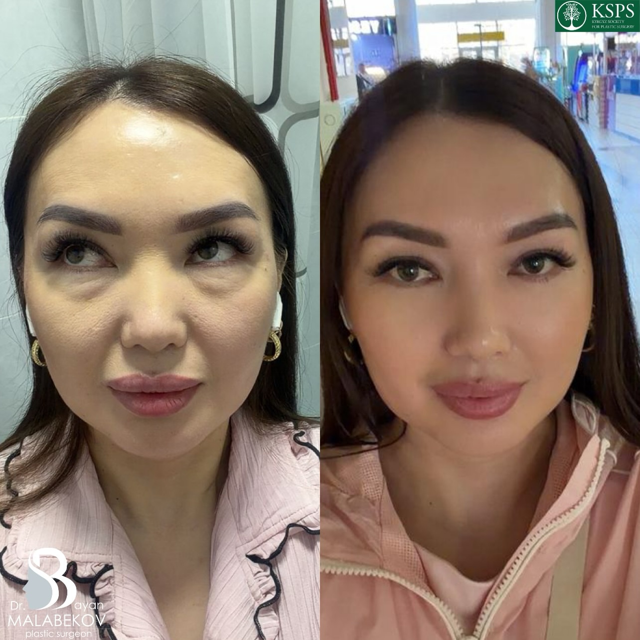 Блефаропластика нижняя