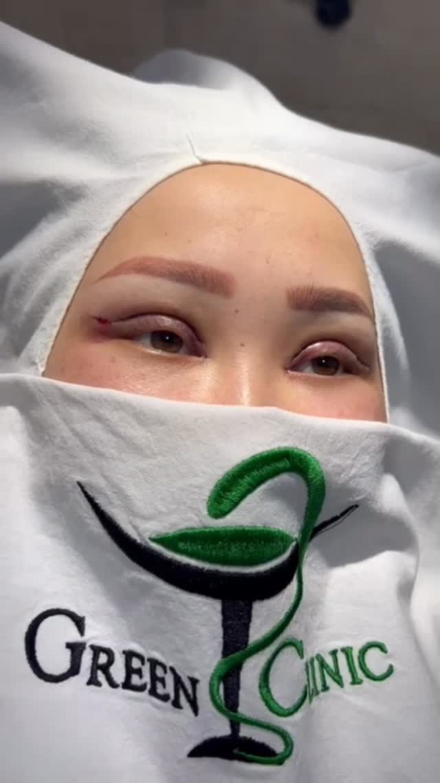 Блефаропластика верхняя